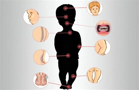 Achondroplasia Causes Signs Standard Therapies Prevention In