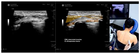 Infraspinatus Fascial Dysfunction as a Cause of Painful Anterior