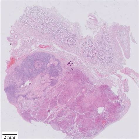 Leydig Cell Tumor With Characteristic Reinke Crystalloids A