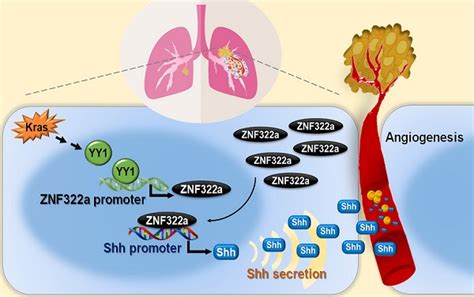 Dysregulated Krasyy1znf322ashh Transcriptional Axis Enhances Neo