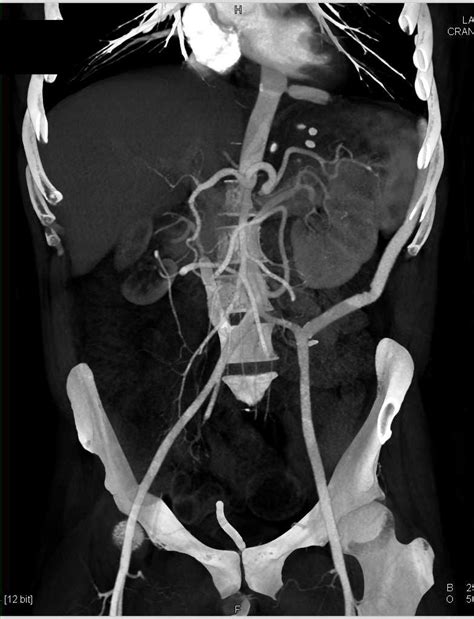 Vascular Aortic Bypass Grafts Vascular Case Studies Ctisus Ct Scanning