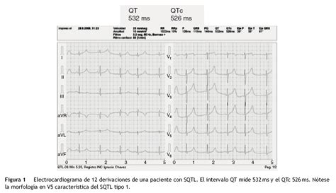El síndrome de QT largo una breve revisión del diagnóstico