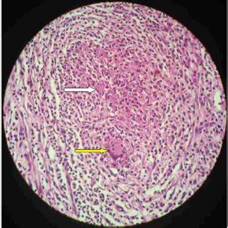 Microphotograph Low Power View Section Taken From Mesenteric Lymph