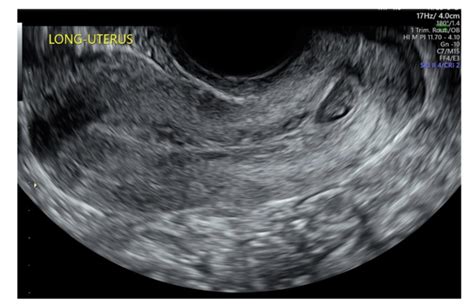 Multidisciplinary Management Of Cervical Ectopic Pregnancy Vdm