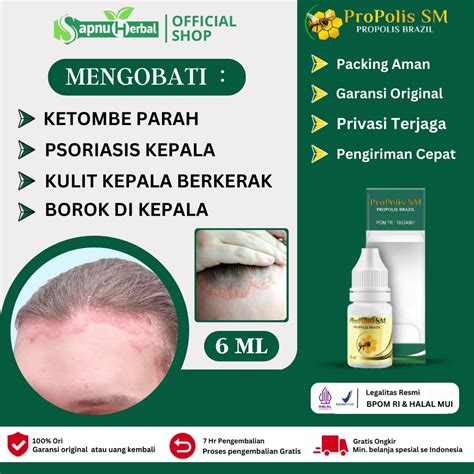 Jual Obat Ketombe Parah Kulit Kepala Kering Bersisik Ketombe Berkerak