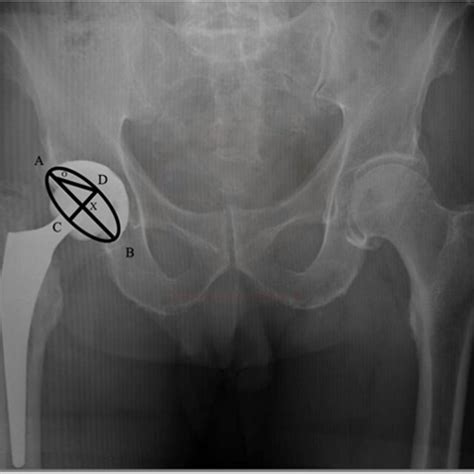 Acetabular Cup Ante Version Calculation Of Acetabular Cup Anteversion