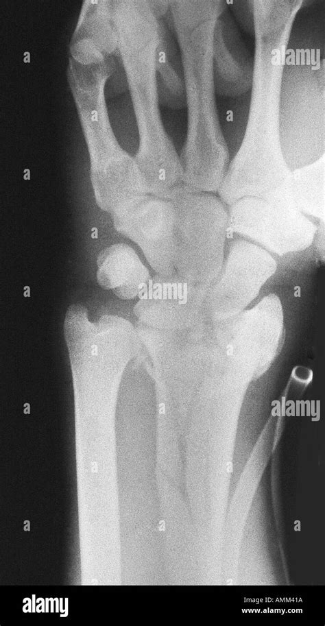 X Ray Distal Radius Wrist Fracture Hi Res Stock Photography And Images