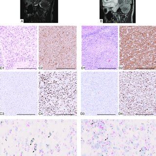 Radiographic And Histologic Findings Of Cases 1 And 2 A And B MR