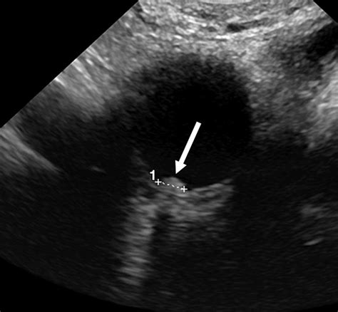 Comparison Of International Ovarian Tumor Analysis Simple Rules To