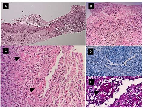 A Photomicrograph Of A Skin Biopsy Comprised Of Epidermis And Dermis