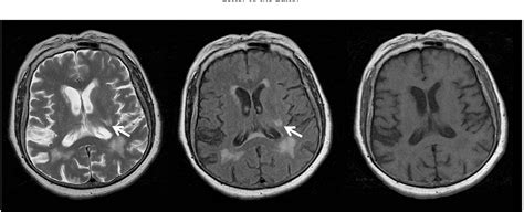 Figure 1 from Hemichorea-hemiballismus in the setting of posterolateral ...