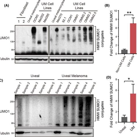 Increased Global Small Ubiquitinlike Modifier Sumo Ylation In Uveal