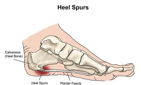 Heel Spur Treatment - Ohio Foot & Ankle Specialists | 30 Podiatry Locations