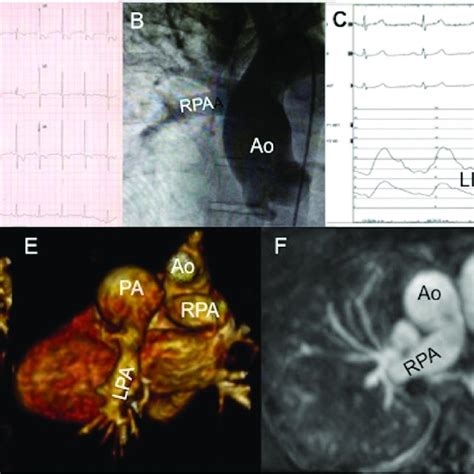 Pdf Multimodality Imaging Of The Anomalous Origin Of The Right