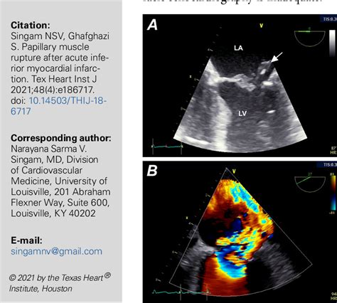 Figure 1 From Papillary Muscle Rupture After Acute Inferior Myocardial