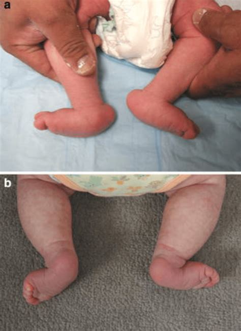 Congenital Vertical Talus An Updated Review PMC