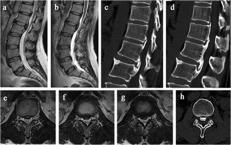 Successful Treatment Of Continuous Ossification Of The Posterior