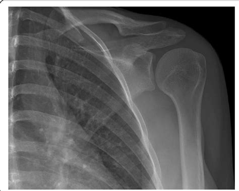 AP radiograph of the nondisplaced pathologic coracoid process fracture ...