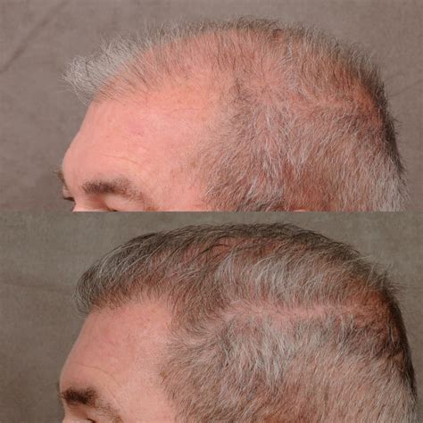 Hair Transplant Hairline Lowering Before Afters Beverly Hills