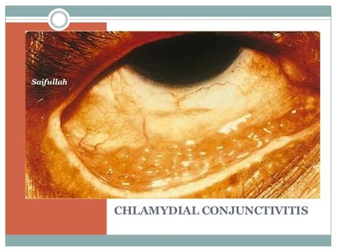 Chlamydia Trachomatis Infection