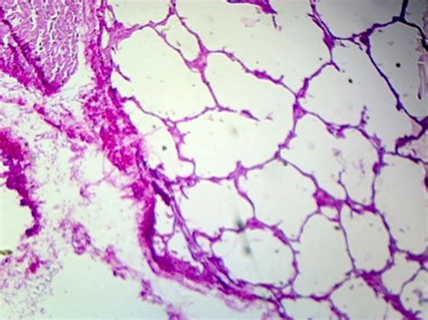 Gsc International Lung Of A Smoker Human Showing Alveoli Section