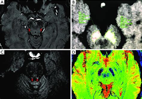 Display Of The Substantia Nigra And Locus Coeruleus Regions And Download Scientific Diagram