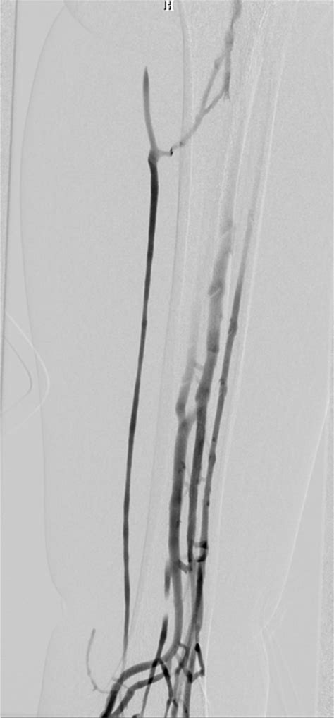 Anterograde Venography Showed A Completely Occlusive Filling Defect In