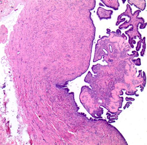 Serous Cystadenoma Ovary Histology