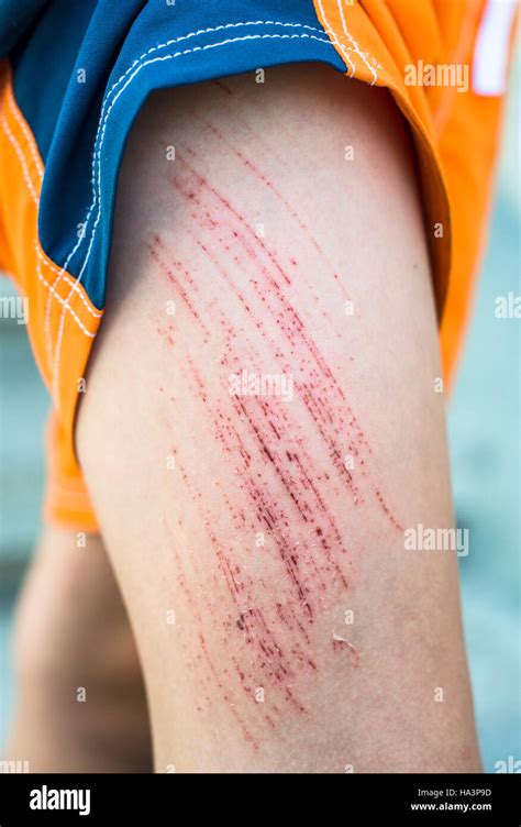 Abrasion Leg Hi Res Stock Photography And Images Alamy