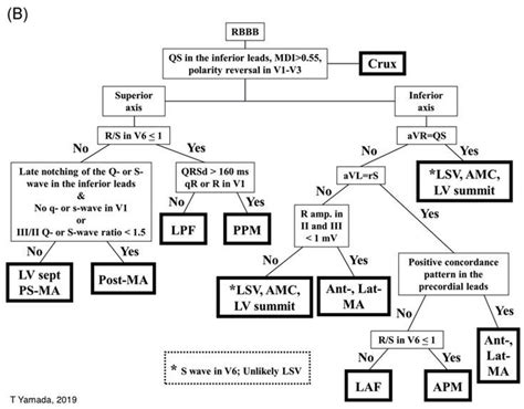 Idiopathic Pvc Localization Rbbb S Wave Concordance Cardiology