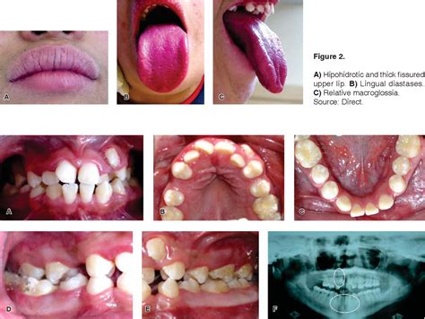 Figure From Enfermedad Periodontal En Pacientes Adolescentes Con