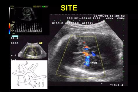 Color Doppler In Fetal Hypoxia PPT