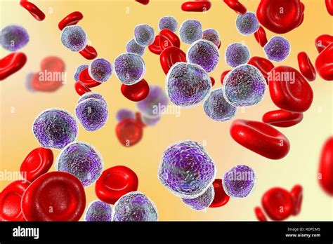 Acute Lymphoblastic Leukaemia Bone Marrow Smear Computer Illustration