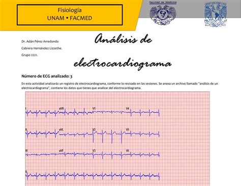 Análisis de un Electrocardiograma Alisson Gomora Gonzalez uDocz