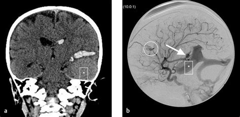 5 Cerebral Arteriovenous Malformations Avms And Dural Arteriovenous Fistulas Davfs