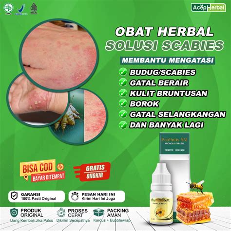 Jual Obat Budug Scabies Kudis Eksim Gatal Ruam Kulit Bintik Bintik Luka