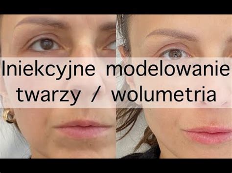 INIEKCYJNE MODELOWANIE TWARZY WOLUMETRIA PRZED I PO YouTube