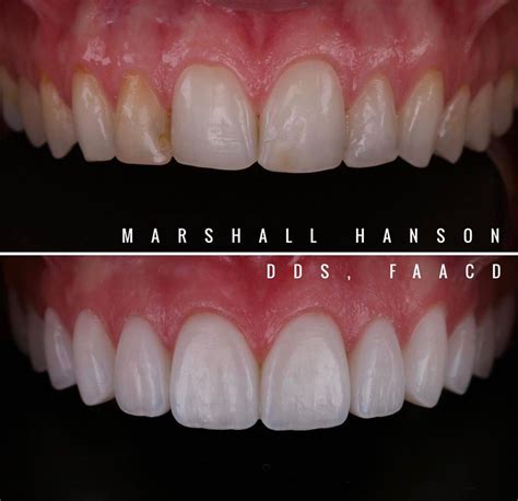 Direct Composite Veneer Masterclass - 29/08/2022- Dr Marshall Hanson ...