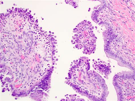 Pathology Outlines Seromucinous Borderline Tumor