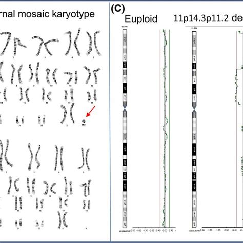 Small Supernumerary Ring Chromosomes A Fetal Autopsy Anomalies Snp Download Scientific