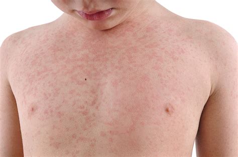 Qu Puede Causar Urticaria En Ni Os Eres Mam