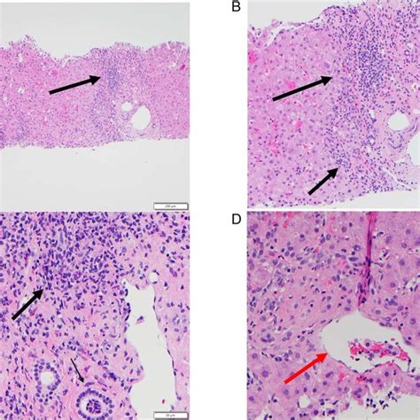 Histologic Features Of Liver Core Biopsy By A Hematoxylin Eosin Stain Download Scientific