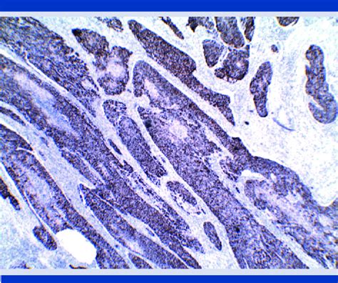 Inmunohistoquímica con positividad citoplasmática para citoqueratina