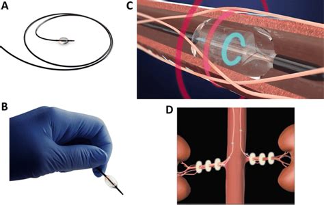 The Paradise Renal Denervation System Catheter A And B Schematic Of Download Scientific