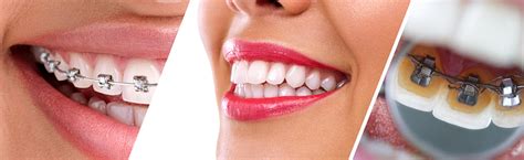 Park Lane Pros And Cons Invisalign Vs Fixed Braces Park Lane Orthodontics