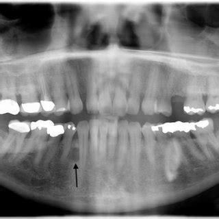 Orthopantomograph Showing A Well Circumscribed Radiolucent Area Between