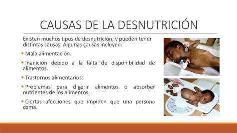 Clasificacion De Desnutricion