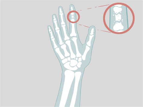 How to Determine if a Finger Is Broken (with Pictures) - wikiHow