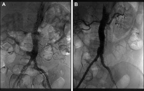 Successful Endovascular Aneurysm Repair For Brucella Mycotic Aneurysm