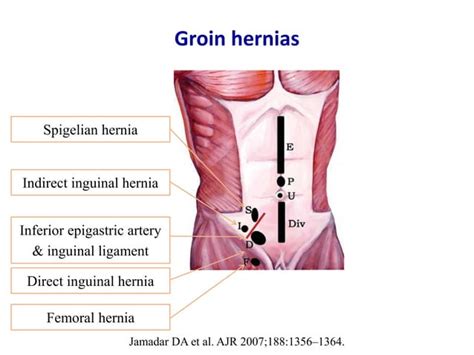 Ultrasound Of Groin And Anterior Abdominal Wall Hernias Ppt